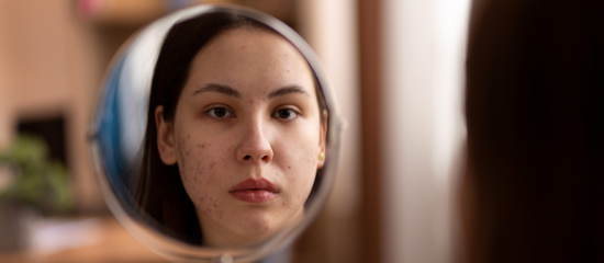 Acne marks treatment Chennai