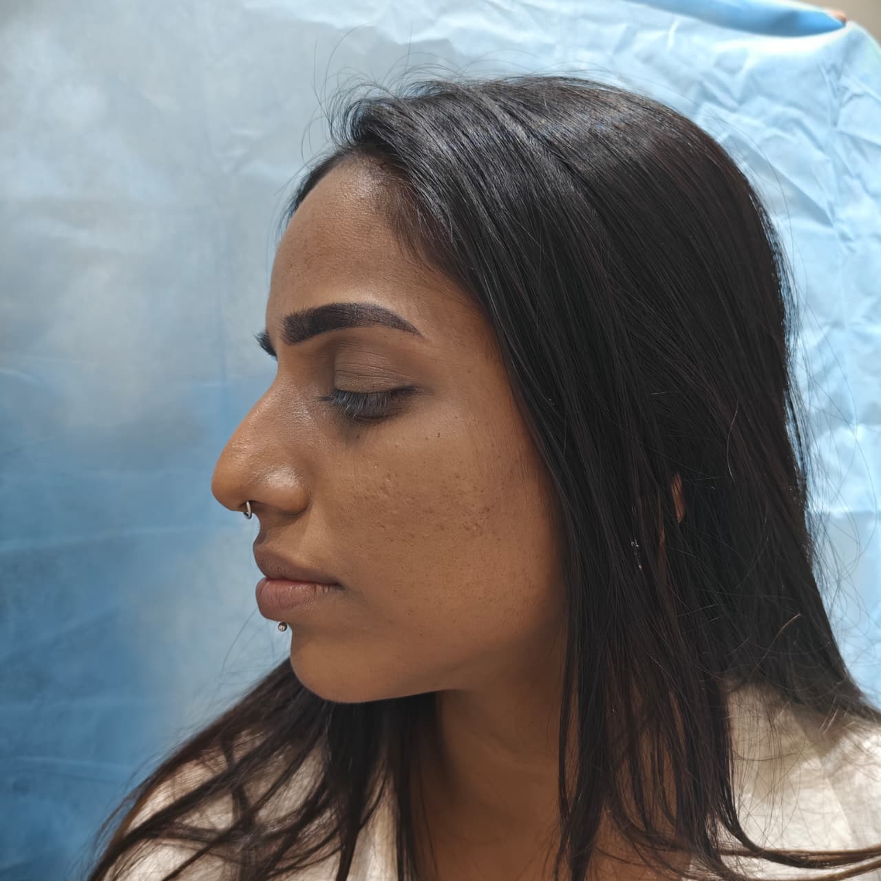 Laser Treatment Area